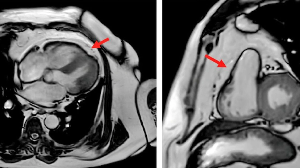 أمراض القلب , رياضة