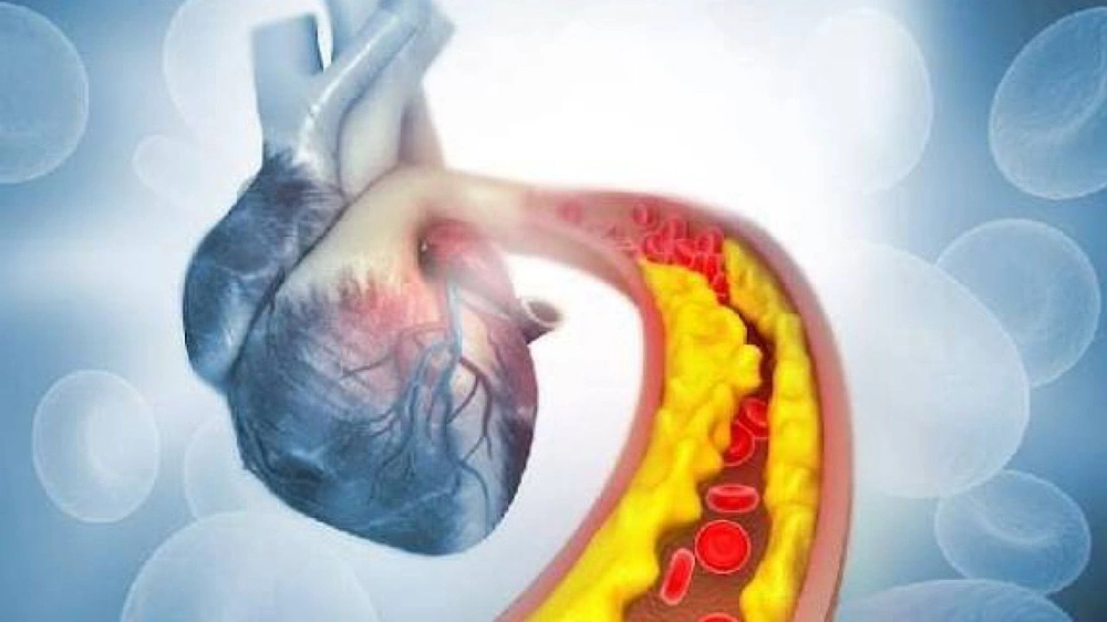 خالد النمر , أمراض القلب , تكلس الشرايين التاجية