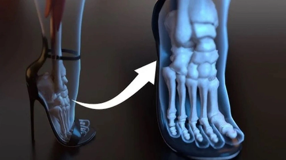 استشاري: الكعب العالي يغير شكل القدمين مع الوقت