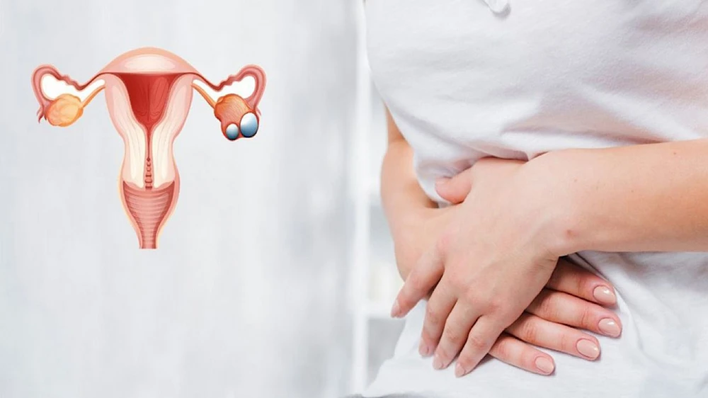 متلازمة تكيس المبايض (PCOS)  ,  اضطرابات هرمونية ,  نساء حول العالم , توابل