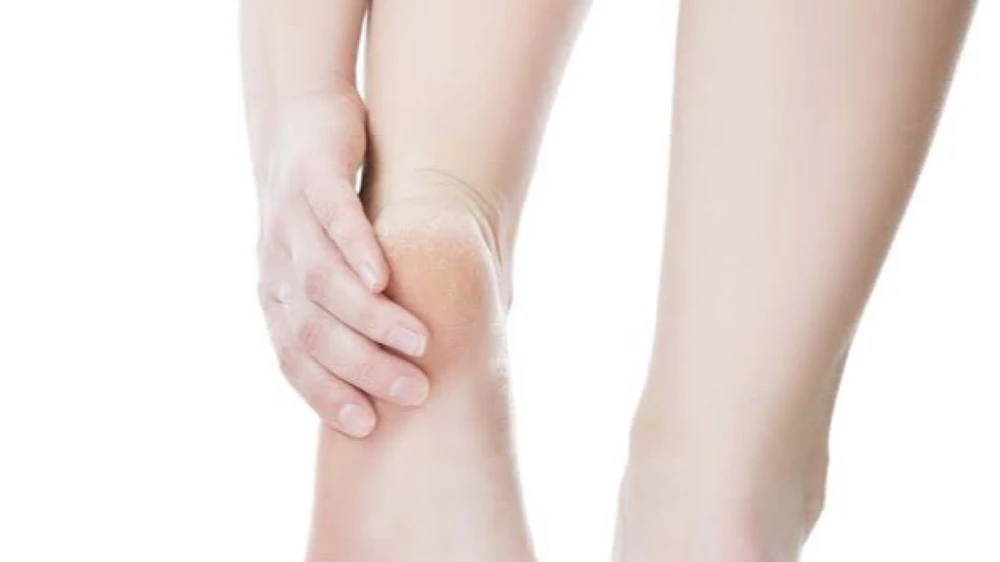 تشقق الكعبين  , سيدات , أمراض جلدية , تجميل