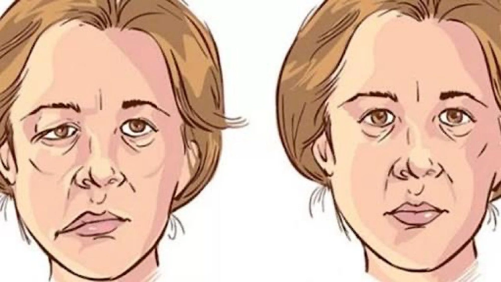 الدكتور هاني العبدلي , &nbsp;استشاري ورئيس قسم المخ والأعصاب , شلل العصب السابع &nbsp;, الشتاء , جلطة الدماغ