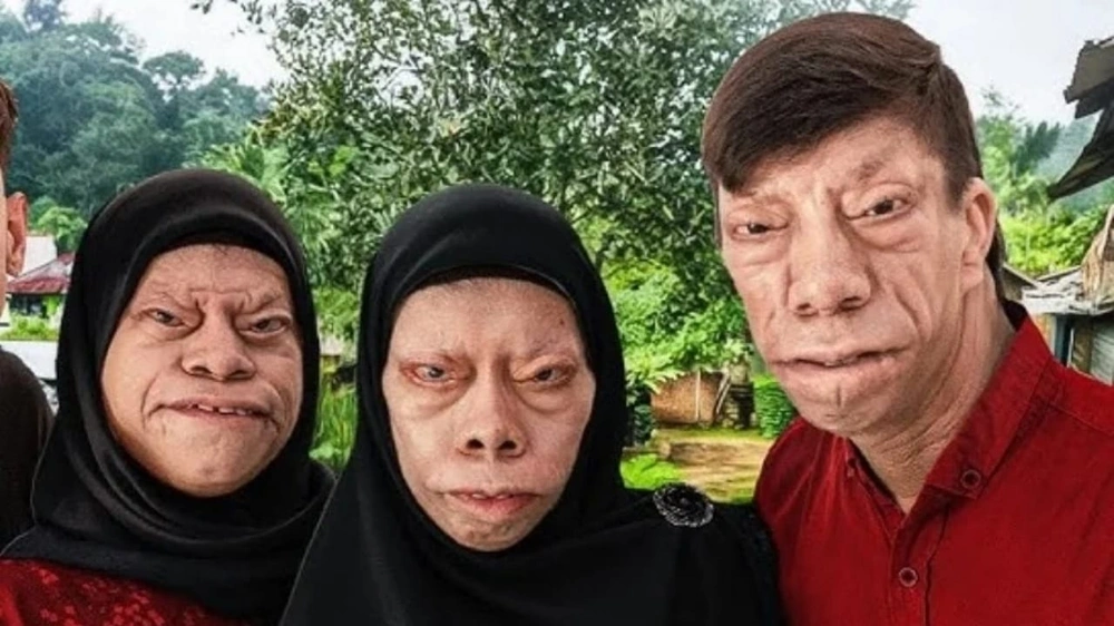 شمال سومطرة ,إندونيسيا ,متلازمة نادرة, السحالي, عائلة إندونيسية, مشاهير مواقع التواصل الاجتماعي ,مواقع التواصل الاجتماعي